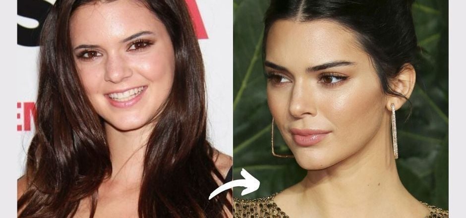 kendal jenners before and after photo