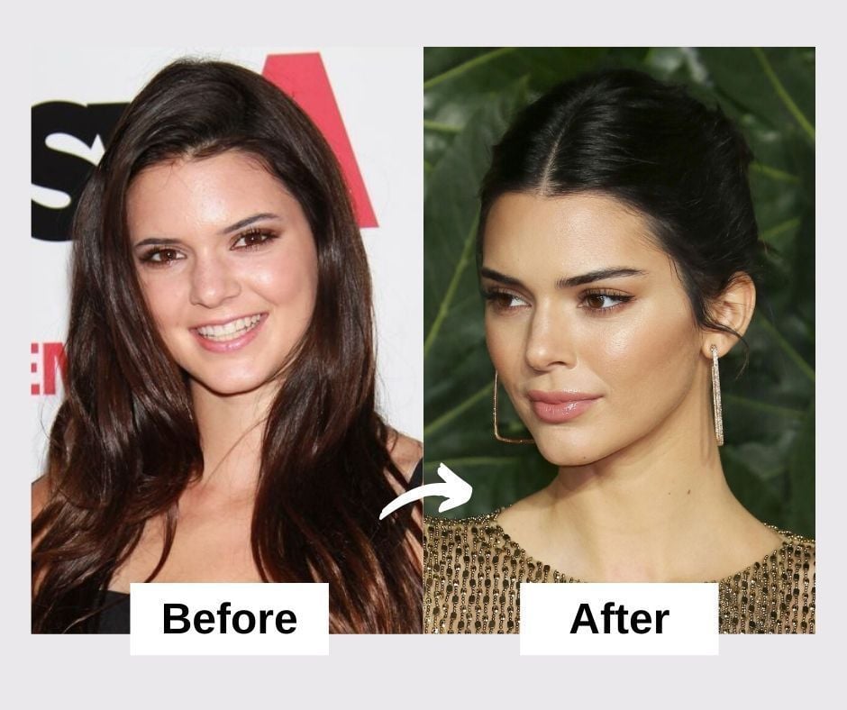 kendal jenners before and after photo
