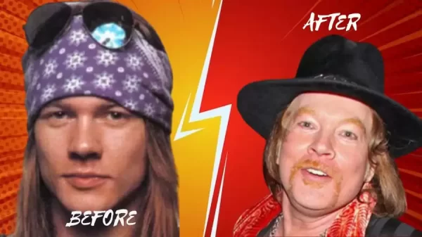 Axl Rose before and after