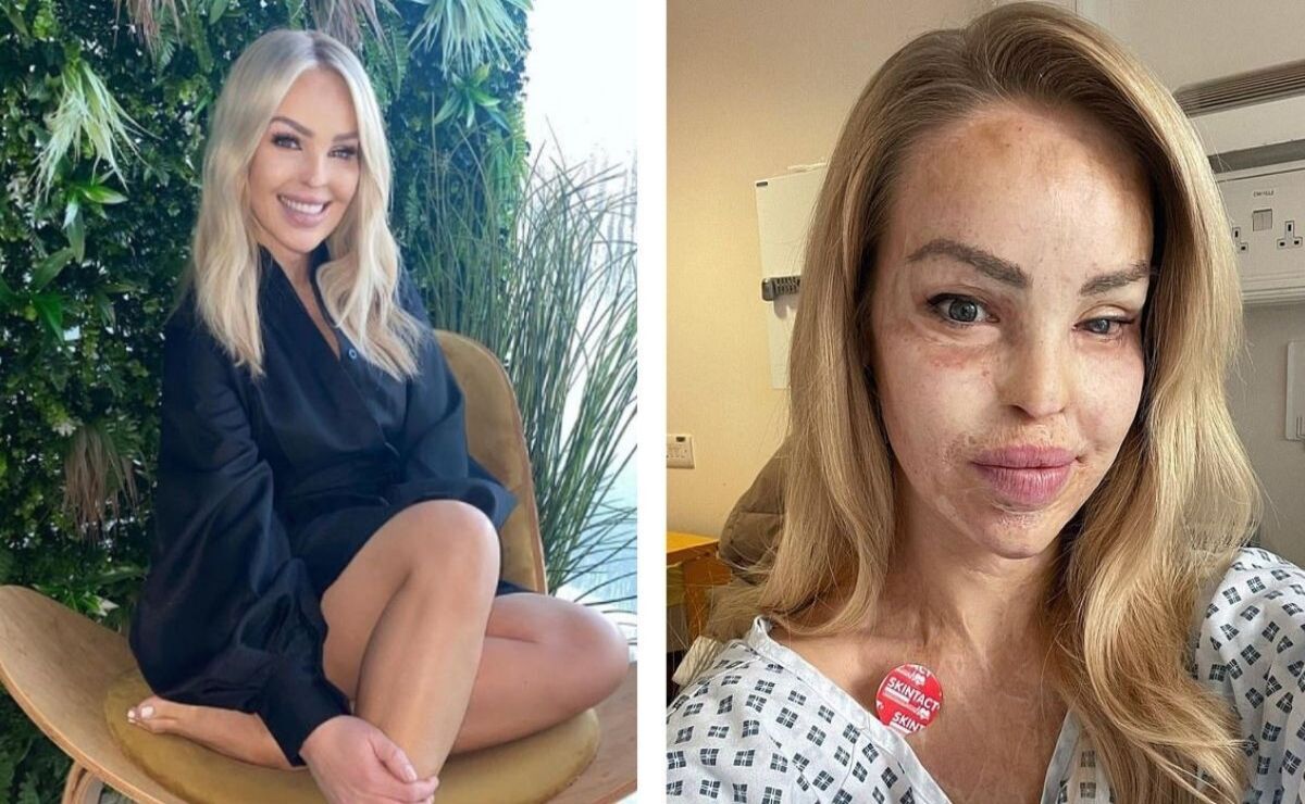 Katie Piper's face got severely burnt after the acid attack in 2008.