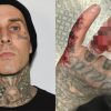 Travis Barker Reveals Gruesome Hand Injury Following Blink-182 Concert in England