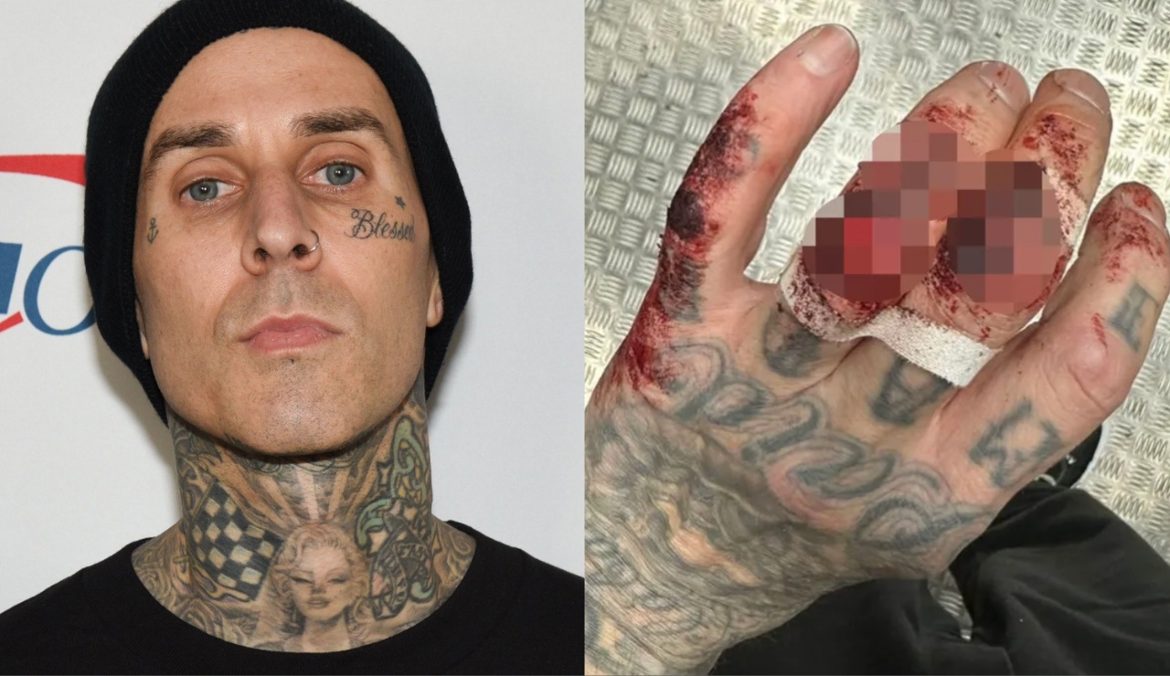 Travis Barker Reveals Gruesome Hand Injury Following Blink-182 Concert in England