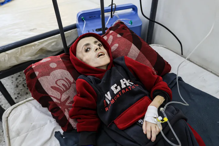 Child from Gaza Famine Photos Dies Due to Malnutrition