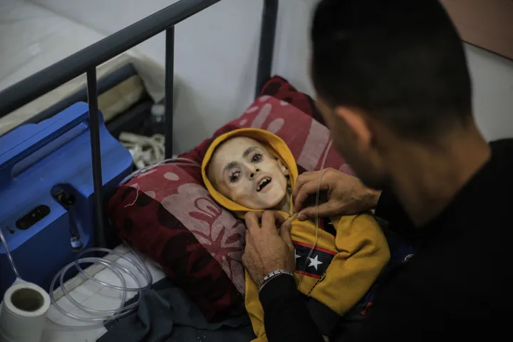 Child from Gaza Famine Photos Dies Due to Malnutrition